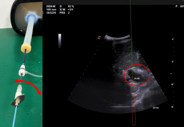 经颈静脉肝内门体分流术（transjugular intrahepatic portosystemic shunt）